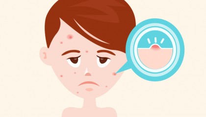 青春痘是如何产生的，长了青春痘该如何护理？