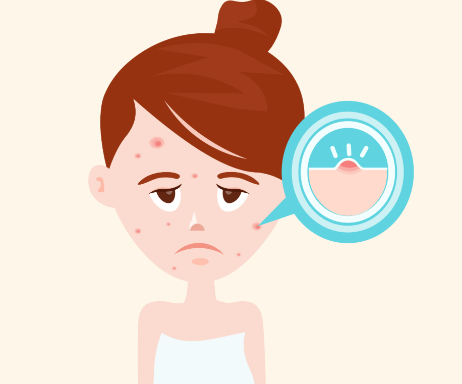 青春痘是如何产生的,长了青春痘该如何护理?